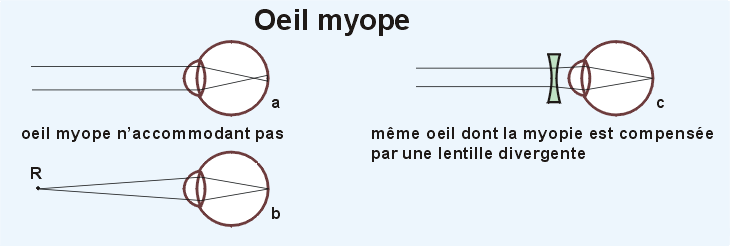 L'oeil myope