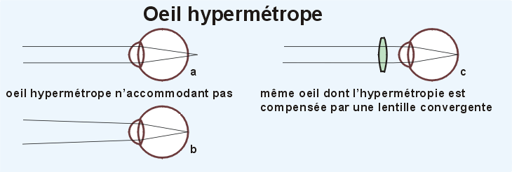 L'oeil hypermétrope
